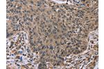 The image on the left is immunohistochemistry of paraffin-embedded Human lung cancer tissue using CSB-PA595868(EDA Antibody) at dilution 1/50, on the right is treated with fusion protein. (Original magnification: 