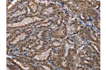 The image on the left is immunohistochemistry of paraffin-embedded Human thyroid cancer tissue using CSB-PA595985(CUL3 Antibody) at dilution 1/30, on the right is treated with fusion protein. (Original magnification: 