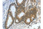 The image on the left is immunohistochemistry of paraffin-embedded Human colon cancer tissue using CSB-PA596240(ASNS Antibody) at dilution 1/50, on the right is treated with fusion protein. (Original magnification: 