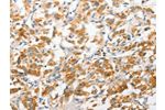 The image on the left is immunohistochemistry of paraffin-embedded Human thyroid cancer tissue using CSB-PA596504(ANAPC2 Antibody) at dilution 1/30, on the right is treated with fusion protein. (Original magnification: 