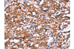The image on the left is immunohistochemistry of paraffin-embedded Human thyroid cancer tissue using CSB-PA596695(GH1 Antibody) at dilution 1/40, on the right is treated with synthetic peptide. (Original magnification: 