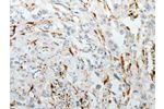 The image on the left is immunohistochemistry of paraffin-embedded Human esophagus cancer tissue using CSB-PA596700(F13A1 Antibody) at dilution 1/25, on the right is treated with fusion protein. (Original magnification: 