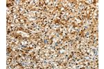 The image on the left is immunohistochemistry of paraffin-embedded Human renal cancer tissue using CSB-PA596830(FZD2 Antibody) at dilution 1/25, on the right is treated with synthetic peptide. (Original magnification: 