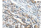 The image on the left is immunohistochemistry of paraffin-embedded Human gastic cancer tissue using CSB-PA596925(BCL2L2 Antibody) at dilution 1/15, on the right is treated with fusion protein. (Original magnification: 