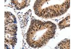The image on the left is immunohistochemistry of paraffin-embedded Human colon cancer tissue using CSB-PA597389(CMTM3 Antibody) at dilution 1/20, on the right is treated with synthetic peptide. (Original magnification: 