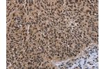 The image on the left is immunohistochemistry of paraffin-embedded Human lung cancer tissue using CSB-PA597470(DLX4 Antibody) at dilution 1/50, on the right is treated with fusion protein. (Original magnification: 