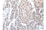 The image on the left is immunohistochemistry of paraffin-embedded Human liver cancer tissue using CSB-PA597642(AQP2 Antibody) at dilution 1/100, on the right is treated with synthetic peptide. (Original magnification: 