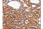 The image on the left is immunohistochemistry of paraffin-embedded Human thyroid cancer tissue using CSB-PA597701(CDK4 Antibody) at dilution 1/10, on the right is treated with fusion protein. (Original magnification: 