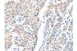 The image on the left is immunohistochemistry of paraffin-embedded Human breast cancer tissue using CSB-PA597708(ADCK1 Antibody) at dilution 1/40, on the right is treated with fusion protein. (Original magnification: 