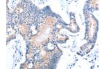 The image on the left is immunohistochemistry of paraffin-embedded Human colon cancer tissue using CSB-PA597950(ACAD11 Antibody) at dilution 1/15, on the right is treated with fusion protein. (Original magnification: 