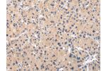 The image on the left is immunohistochemistry of paraffin-embedded Human liver cancer tissue using CSB-PA598098(CHRM5 Antibody) at dilution 1/25, on the right is treated with synthetic peptide. (Original magnification: 