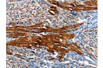 The image on the left is immunohistochemistry of paraffin-embedded Human liver cancer tissue using CSB-PA598136(AOX1 Antibody) at dilution 1/65, on the right is treated with fusion protein. (Original magnification: 
