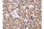 The image on the left is immunohistochemistry of paraffin-embedded Human thyroid cancer tissue using CSB-PA598159(CSF2RB Antibody) at dilution 1/25, on the right is treated with synthetic peptide. (Original magnification: 