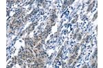 The image on the left is immunohistochemistry of paraffin-embedded Human gastic cancer tissue using CSB-PA598205(BNIP3L Antibody) at dilution 1/30, on the right is treated with synthetic peptide. (Original magnification: 