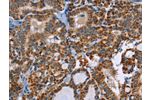 The image on the left is immunohistochemistry of paraffin-embedded Human thyroid cancer tissue using CSB-PA598314(ABCB1 Antibody) at dilution 1/30, on the right is treated with synthetic peptide. (Original magnification: 