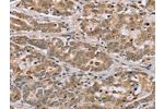 The image on the left is immunohistochemistry of paraffin-embedded Human liver cancer tissue using CSB-PA598332(CLEC16A Antibody) at dilution 1/45, on the right is treated with synthetic peptide. (Original magnification: 