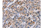 The image on the left is immunohistochemistry of paraffin-embedded Human liver cancer tissue using CSB-PA598713(ENPP5 Antibody) at dilution 1/40, on the right is treated with fusion protein. (Original magnification: 