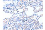 The image on the left is immunohistochemistry of paraffin-embedded Human thyroid cancer tissue using CSB-PA598870(ACAD8 Antibody) at dilution 1/20, on the right is treated with fusion protein. (Original magnification: 