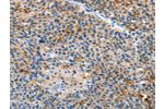 The image on the left is immunohistochemistry of paraffin-embedded Human liver cancer tissue using CSB-PA598875(ALS2 Antibody) at dilution 1/25, on the right is treated with fusion protein. (Original magnification: 