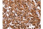 The image on the left is immunohistochemistry of paraffin-embedded Human thyroid cancer tissue using CSB-PA599022(ERAS Antibody) at dilution 1/40, on the right is treated with synthetic peptide. (Original magnification: 