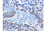 The image on the left is immunohistochemistry of paraffin-embedded Human esophagus cancer tissue using CSB-PA599265(CNGA2 Antibody) at dilution 1/25, on the right is treated with fusion protein. (Original magnification: 