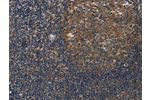 The image on the left is immunohistochemistry of paraffin-embedded Human tonsil tissue using CSB-PA599384(DSP Antibody) at dilution 1/40, on the right is treated with synthetic peptide. (Original magnification: 