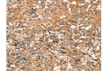 The image on the left is immunohistochemistry of paraffin-embedded Human thyroid cancer tissue using CSB-PA599713(ARFGEF2 Antibody) at dilution 1/50, on the right is treated with synthetic peptide. (Original magnification: 