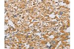 The image on the left is immunohistochemistry of paraffin-embedded Human thyroid cancer tissue using CSB-PA600132(ARHGEF7 Antibody) at dilution 1/40, on the right is treated with fusion protein. (Original magnification: 