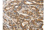 The image on the left is immunohistochemistry of paraffin-embedded Human gastic cancer tissue using CSB-PA601738(ANGPTL1 Antibody) at dilution 1/40, on the right is treated with fusion protein. (Original magnification: 