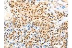 The image on the left is immunohistochemistry of paraffin-embedded Human esophagus cancer tissue using CSB-PA605758(APPL1 Antibody) at dilution 1/70, on the right is treated with fusion protein. (Original magnification: 