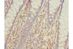 Immunohistochemistry of paraffin-embedded human colon cancer using CSB-PA605995ESR1HU at dilution 1:100
