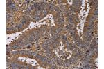 The image on the left is immunohistochemistry of paraffin-embedded Human colon cancer tissue using CSB-PA607012(FADS1 Antibody) at dilution 1/60, on the right is treated with fusion protein. (Original magnification: 