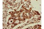 Immunohistochemistry of paraffin-embedded human pancreatic cancer using CSB-PA608122LA01HU at dilution of 1:100