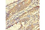 Immunohistochemistry of paraffin-embedded human colon cancer using CSB-PA610370LA01HU at dilution 1:100
