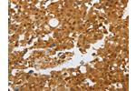 The image on the left is immunohistochemistry of paraffin-embedded Human breast cancer tissue using CSB-PA611485(AKAP8L Antibody) at dilution 1/25, on the right is treated with synthetic peptide. (Original magnification: 