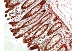 Immunohistochemical analysis of paraffin-embedded Human Colon Carcinoma Tissue using ATM Rabbit pAb diluted at 1:500.