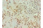 Immunohistochemistry of paraffin-embedded human breast cancer using CSB-PA613265ESR1HU at dilution 1:100