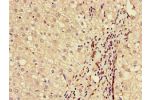 Immunohistochemistry of paraffin-embedded human liver cancer using CSB-PA613484LA01HU at dilution of 1:100