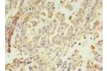 Immunohistochemistry of paraffin-embedded human lung cancer using CSB-PA613489LA01HU at dilution of 1:100