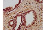IHC image of CSB-PA613507LA01HU diluted at 1:400 and staining in paraffin-embedded human prostate cancer performed on a Leica BondTM system. After dewaxing and hydration, antigen retrieval was mediated by high pressure in a citrate buffer (pH 6.0). Sectio