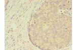 Immunohistochemistry of paraffin-embedded human gastric cancer using CSB-PA613538LA01HU at dilution of 1:100