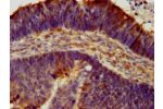 IHC image of CSB-PA613683LA01HU diluted at 1:300 and staining in paraffin-embedded human ovarian cancer performed on a Leica BondTM system. After dewaxing and hydration, antigen retrieval was mediated by high pressure in a citrate buffer (pH 6.0). Section