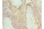 Immunohistochemistry of paraffin-embedded human colon cancer using CSB-PA614436ESR2HU at dilution 1:100
