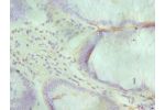 Immunohistochemistry of paraffin-embedded human colon cancer using CSB-PA614439ESR1HU at dilution 1:100