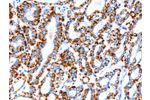 The image on the left is immunohistochemistry of paraffin-embedded Human thyroid cancer tissue using CSB-PA614749(ACAA2 Antibody) at dilution 1/20, on the right is treated with fusion protein. (Original magnification: 