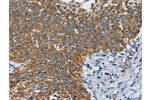 The image on the left is immunohistochemistry of paraffin-embedded Human cervical cancer tissue using CSB-PA614837(ANKHD1 Antibody) at dilution 1/40, on the right is treated with fusion protein. (Original magnification: 
