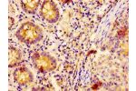 IHC image of CSB-PA615539LA01HU diluted at 1:400 and staining in paraffin-embedded human colon cancer performed on a Leica BondTM system. After dewaxing and hydration, antigen retrieval was mediated by high pressure in a citrate buffer (pH 6.0). Section w