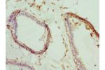 Immunohistochemistry of paraffin-embedded human breast cancer using CSB-PA615541DSR1HU at dilution 1:100