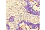 Immunohistochemistry of paraffin-embedded human ovarian cancer using CSB-PA615670LA01HU at dilution of 1:100