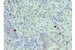 Immunohistochemistry of paraffin-embedded human lung cancer using CSB-PA615677ESR2HUat dilution 1:100